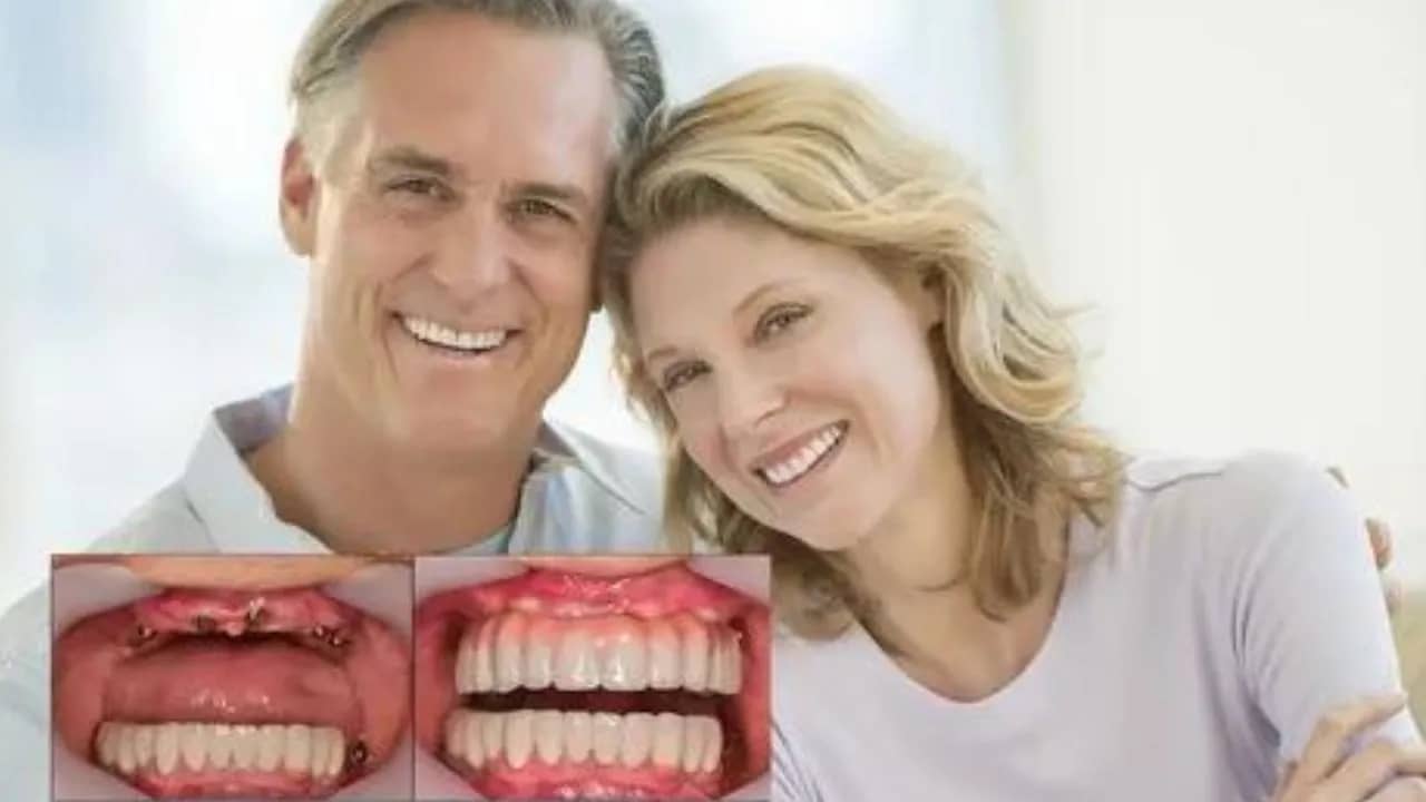 Cost Of Full Mouth Dental Implants